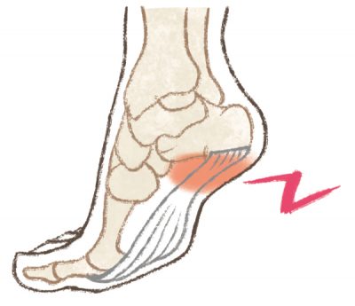 足底腱膜炎 豊橋市 大手口コミサイト上位のふたば接骨院