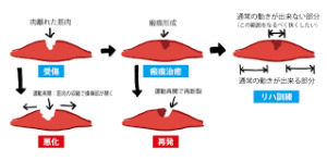 病院 整形外科でも治らない肉離れは豊橋市ふたば接骨院へ一度ご相談下さい